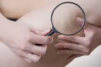Lente di ingrandimento evidenzia una vena varicosa su una gamba