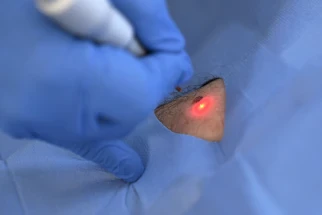 dettaglio trattamento laser dermatologico