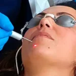 trattamento laser CO2